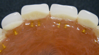 Polyamidové snímatelné náhrady – vložení kovových prvků, fixace konfekčních zubů v bázi