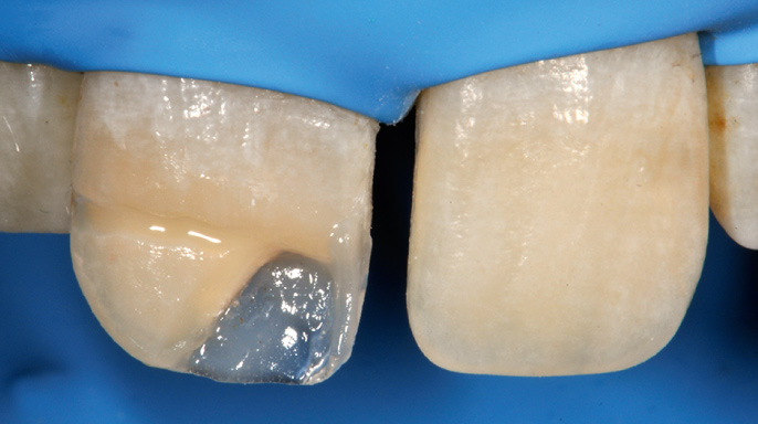 Two-layer technika rekonstrukce frontálního zubu po úrazu