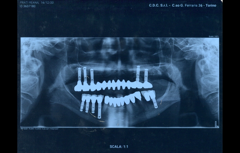 Obr. 7: Ortopantomografie před ošetřením.