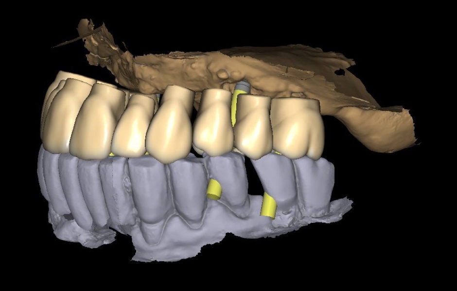 Obr. 10c: Virtuální navrhování zubního oblouku budoucí hybridní náhrady.