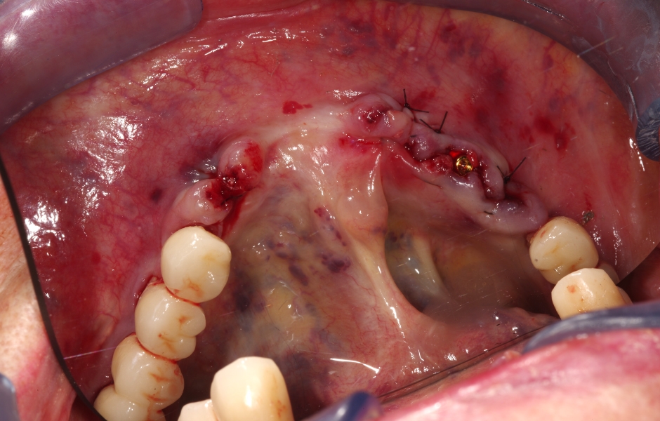 Obr. 21b: Extrakce zbylých zubů v dolní čelisti a zavedení implantátu do oblasti zubu 33. Zevrubný popis protetického ošetření dolní čelisti není předmětem tohoto sdělení.