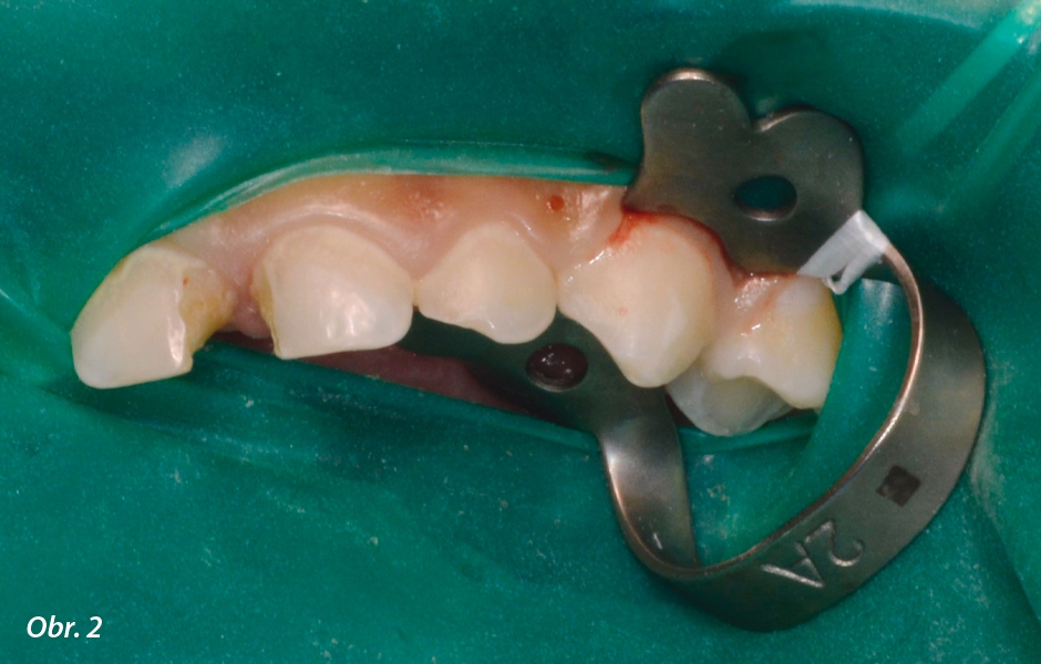 Pulpotomie u frontálních zubů: Izolace kofferdamem