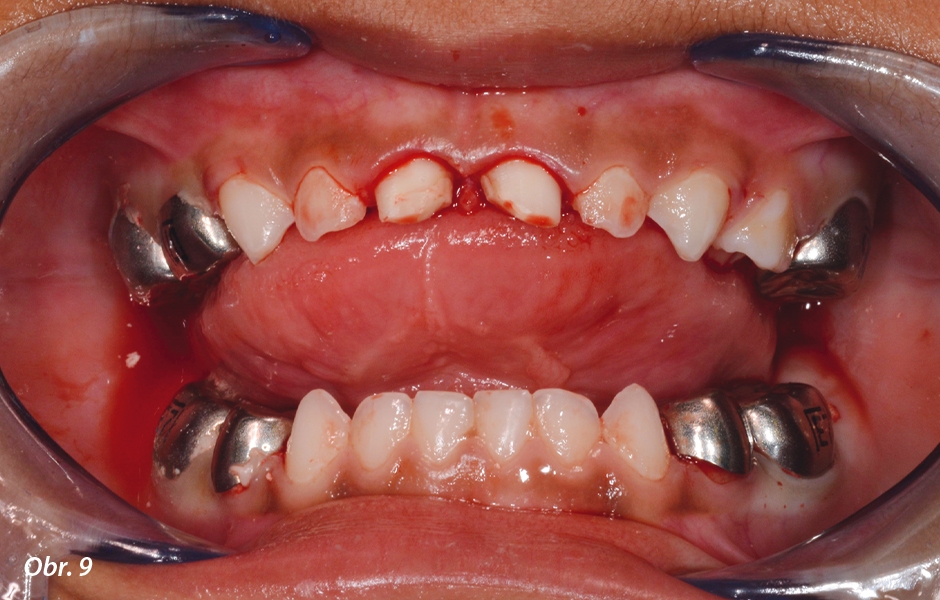 Pulpotomie u frontálních zubů: Preparace pro definitivní náhradu