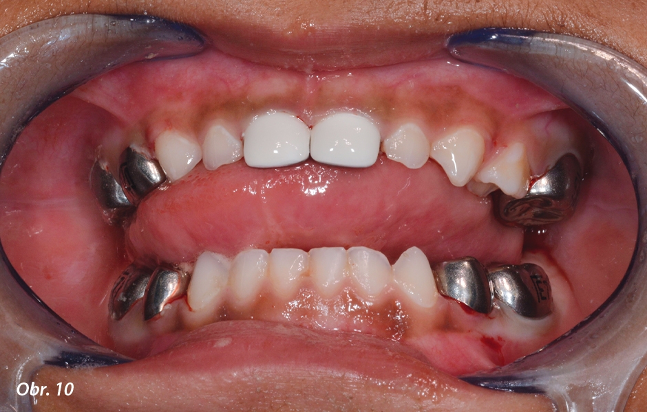 Pulpotomie u frontálních zubů: Definitivní náhrada