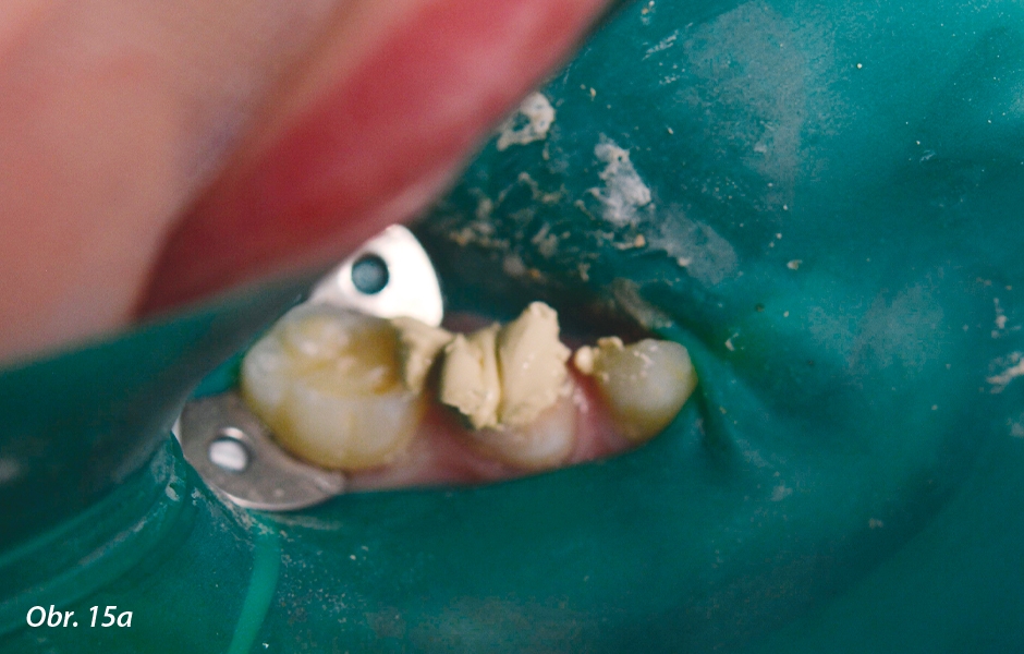 Pulpotomie u distálních zubů: Nanášení Biodentine™
