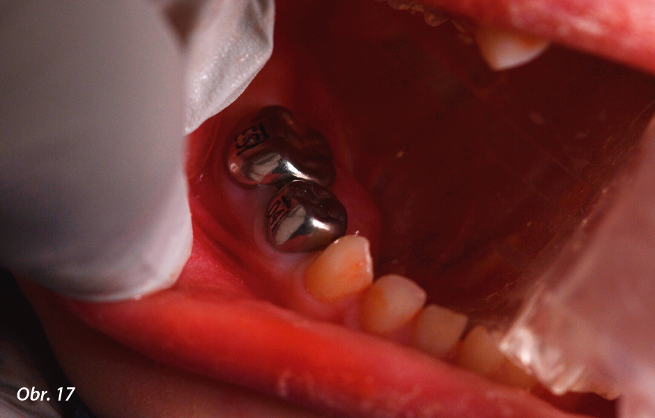 Pulpotomie u distálních zubů: Definitivní náhrada