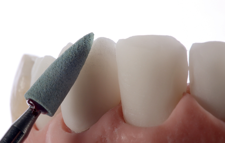 Obr. 16a: Labiální cut-back za účelem individualizace presovaných náhrad frontálních zubů.