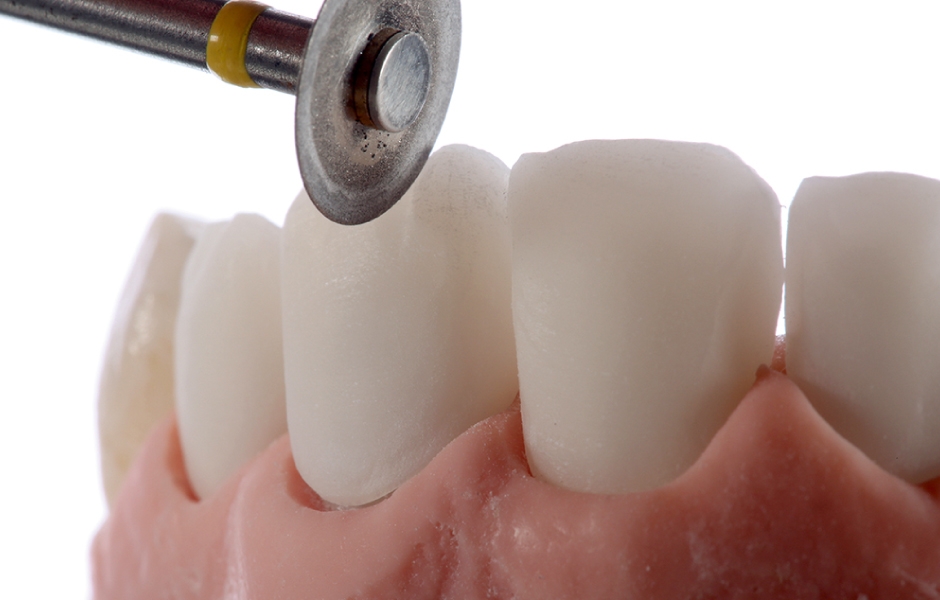 Obr. 16b: Labiální cut-back za účelem individualizace presovaných náhrad frontálních zubů.