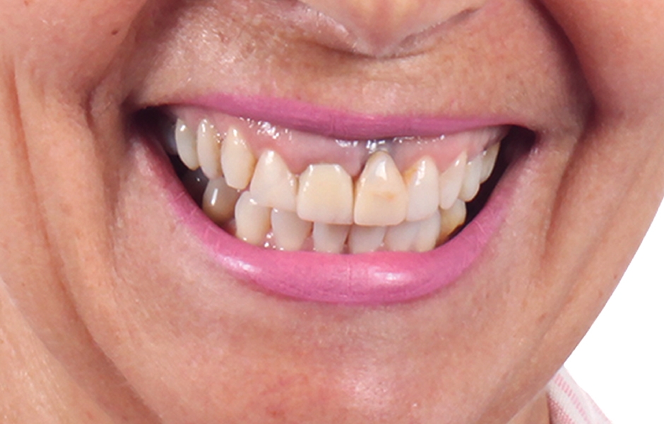 Obr. 1a: Počáteční klinický stav: disharmonie červené/bílé estetiky úsměvu, diskolorace zubů s výplněmi a pravděpodobně nevyhovující pozice implantátu v oblasti zubu 21.