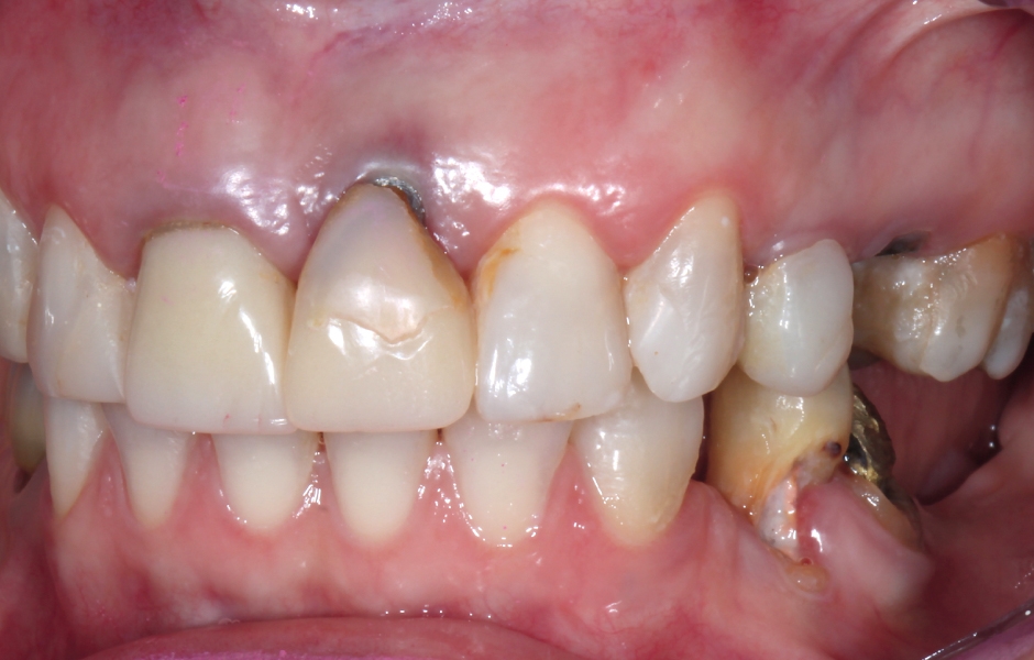 Obr. 1b: Počáteční klinický stav: disharmonie červené/bílé estetiky úsměvu, diskolorace zubů s výplněmi a pravděpodobně nevyhovující pozice implantátu v oblasti zubu 21.