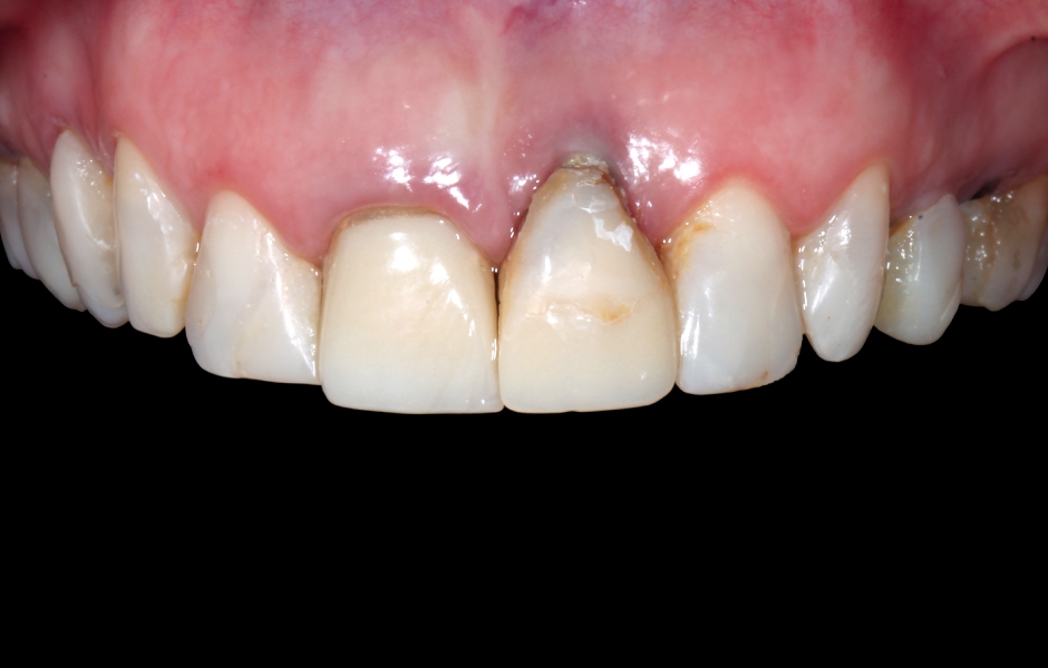 Obr. 1c: Počáteční klinický stav: disharmonie červené/bílé estetiky úsměvu, diskolorace zubů s výplněmi a pravděpodobně nevyhovující pozice implantátu v oblasti zubu 21.