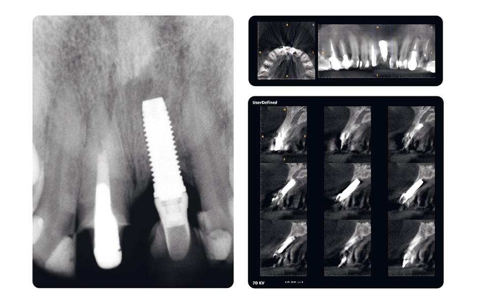 Obr. 2: Periapikální RTG snímek a CBCT snímky potvrzují nevyhovující pozici implantátu v oblasti zubu 21.