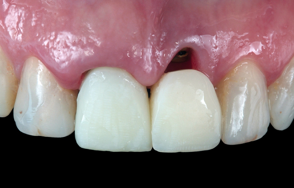 Obr. 4a: Provizorní náhrada fixovaná pouze na kořenové nástavbě v oblasti zubu 11.