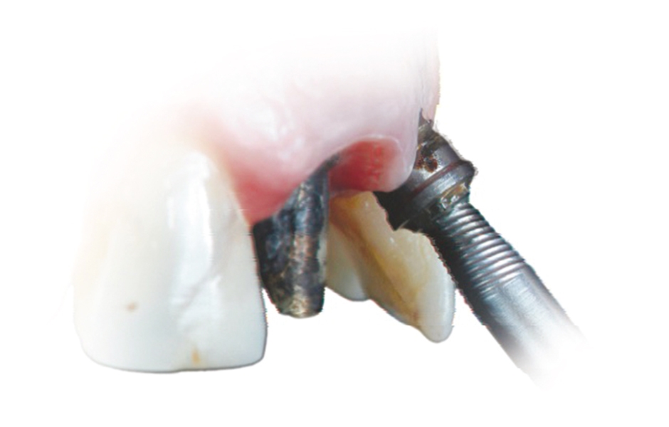 Obr. 4b: Odstranění nevyhovujícího implantátu.