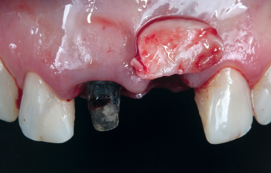 Obr. 4c: Transplantace štěpu měkkých tkání v oblasti zubu 21.