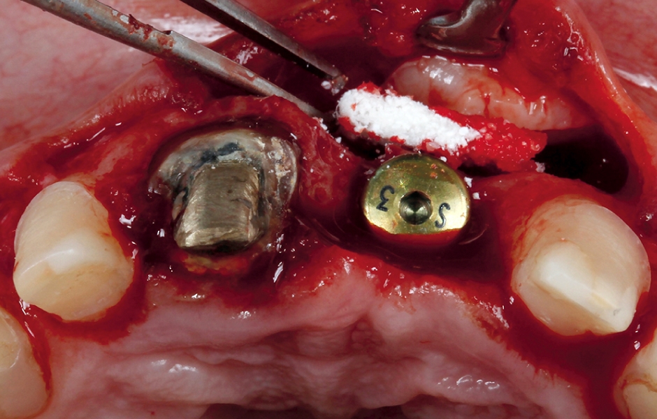 Obr. 5a: Transplantace kostního štěpu při zavádění implantátu v oblasti zubu 21.