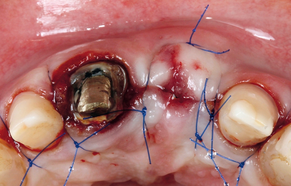 Obr. 5b: Sutura měkkých tkání nad zavedeným implantátem v oblasti zubu 21.