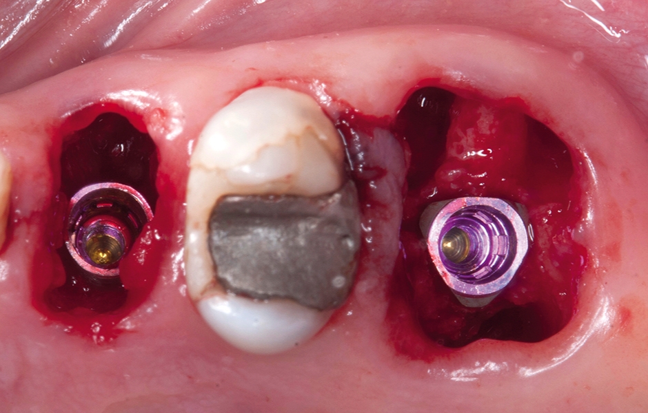 Obr. 6a: Zavedení implantátů MIS V3b+.