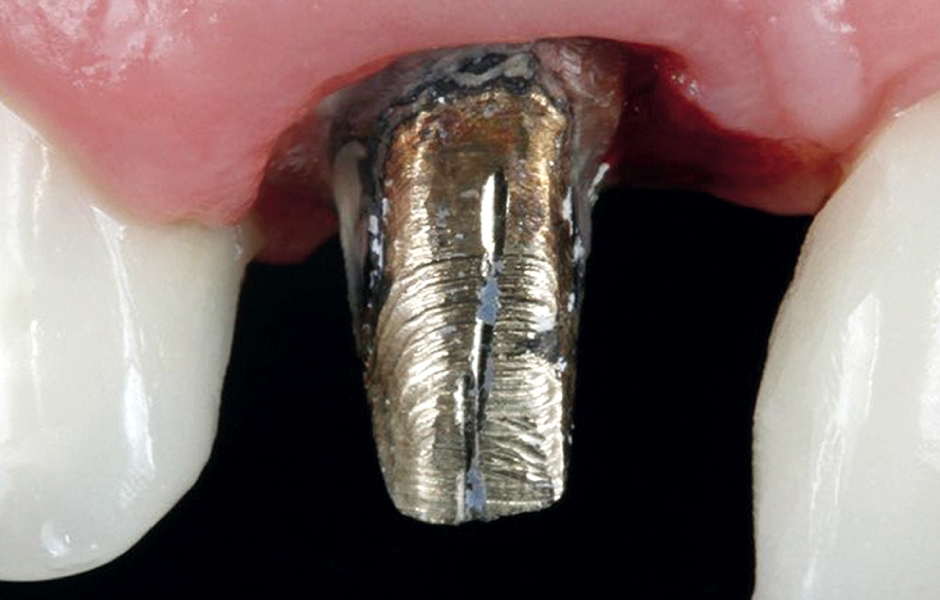 Obr. 7a: Kovovou kořenovou nástavbu v místě zubu 11 bylo nutno odstranit.