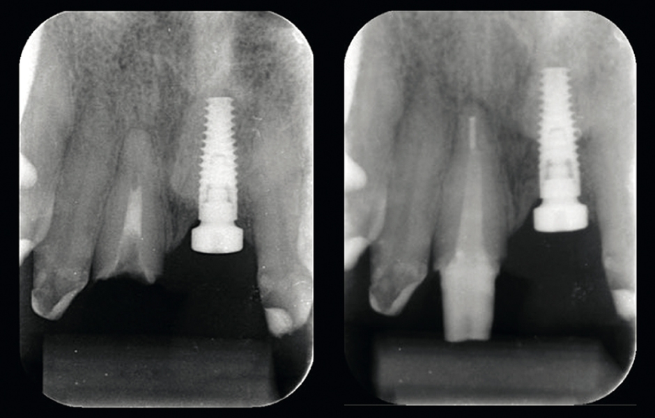 Obr. 8b: RTG snímek před a po ošetření pahýlu zubu 11 novou kompozitní kořenovou nástavbou.