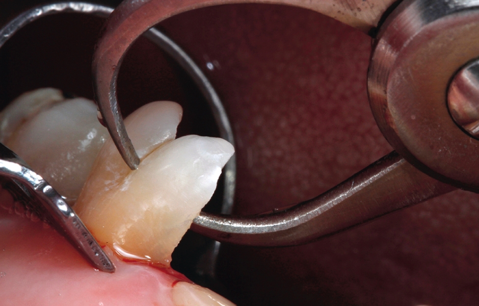 Obr. 8c: Analýza zbylé tvrdé tkáně u vitálního zubu.