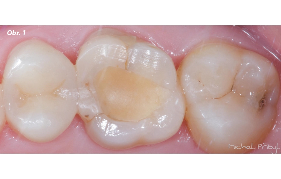 Počáteční situace, zub 16 po endodontickém ošetření