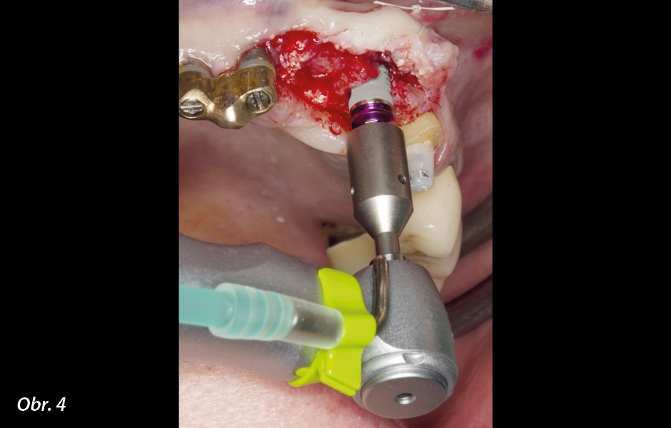 Zavádění implantátu pomocí mikromotoru a kolénkového násadce WS-75 L při poměru 20 : 1 (program P5).