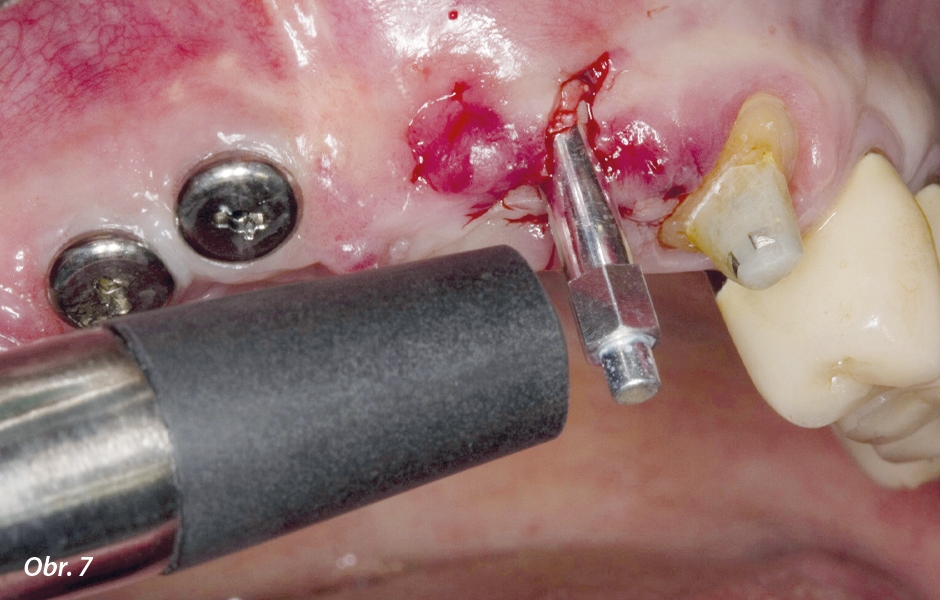 Již po čtyřech měsících byla pomocí modulu W&H Osstell ISQ během obnažení změřena stabilita implantátu v oblasti zubu 22 (naměřené hodnoty: meziálně 68, vestibulárně 64 = střední stabilita).