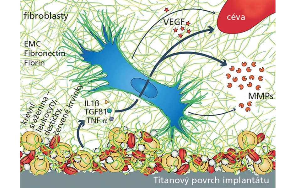 Ilustrace toho, jak fibroblasty a buněčná sraženina adherující na titanový povrch INICELL mohou synergicky zvednout angiogenní potenciál a mít tak pozitivní vliv na remodelační kapacitu