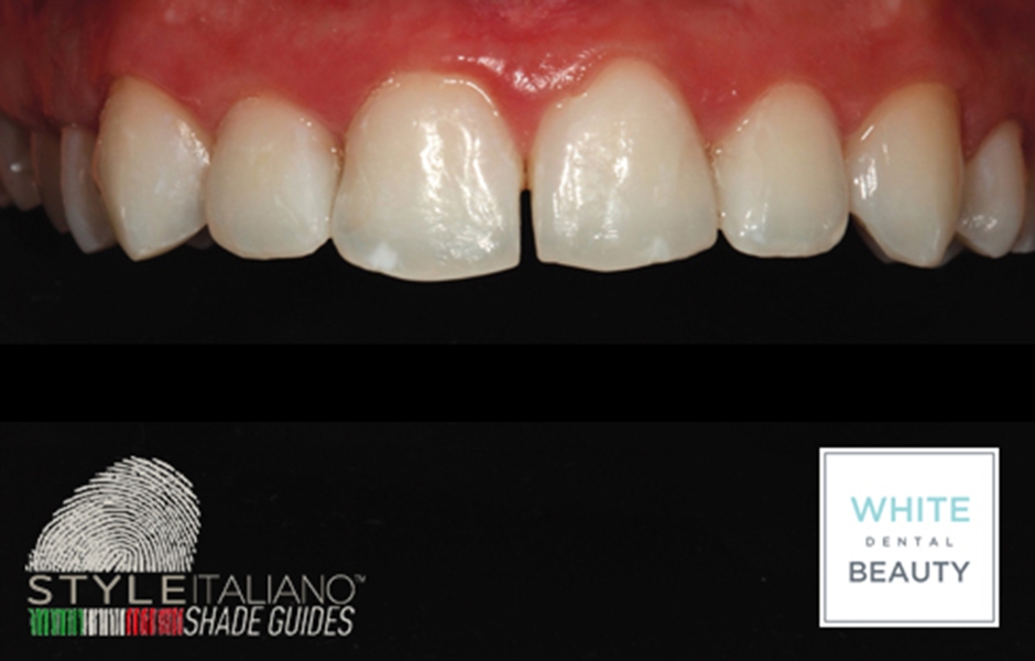 Použitím nosiče s gelem obsahujícím 6% peroxid vodíku aplikovaným 30 minut denně se pacientův odstín zubů změnil z A35 na OM1 již za dva týdny. Zuby tak byly úspěšně připraveny pro další část zákroku - přímé výplně.