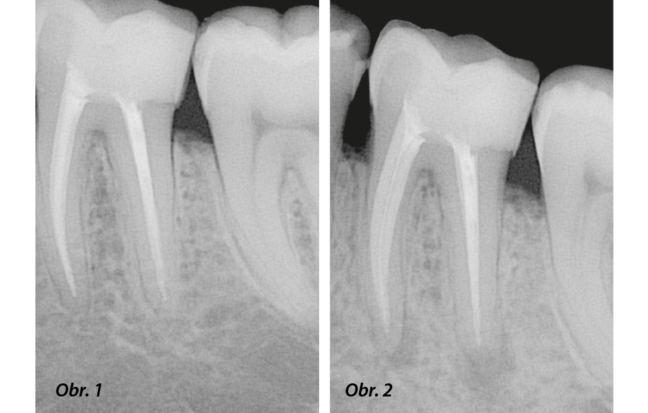 Obr. 1: RTG snímek počátečního ošetření zubu 36 v roce 2015. Obr. 2: RTG snímek zubu 36 před opětovným ošetřením v roce 2020.
