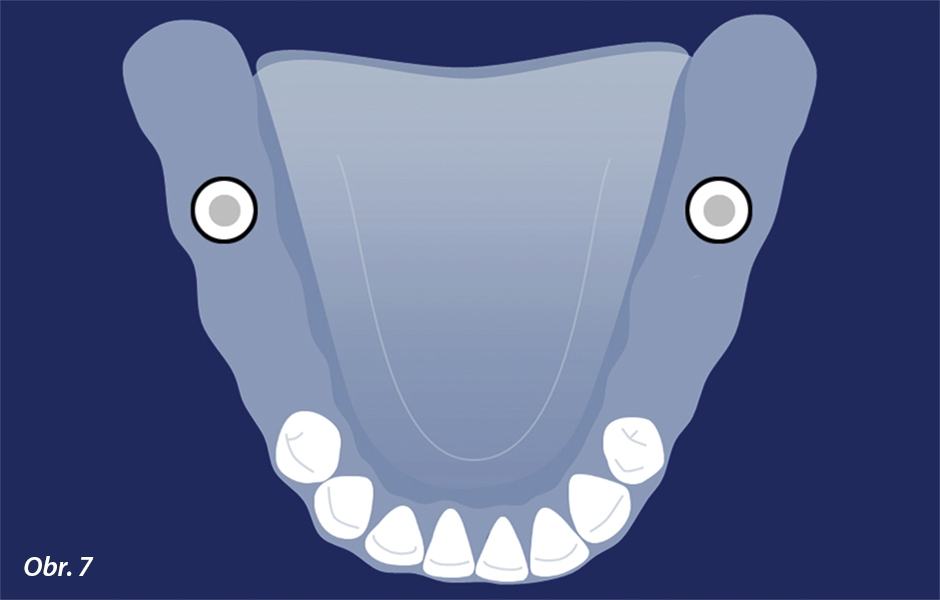 Situace s oboustranně zkráceným zubním obloukem v dolní čelisti, kde může umístění implantátu v oblasti molárů poskytnout strategickou oporu nebo kotvení pro ČSN