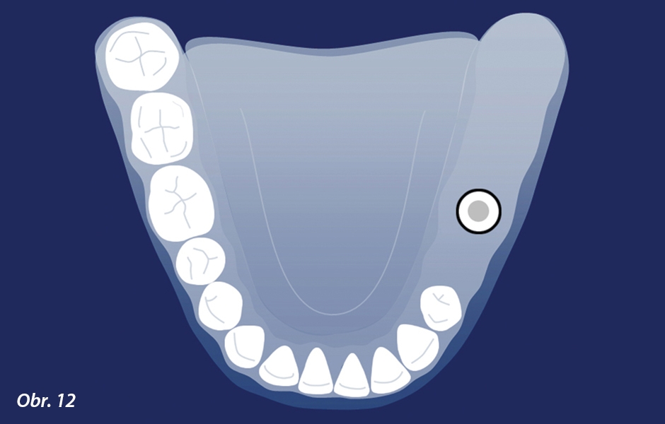 Kennedyho klasifikace II. třídy s jednostranně zkráceným zubním obloukem, kde byl implantát zaveden v oblasti levého moláru, aby bylo dosaženo strategických výhod konfigurace III. třídy