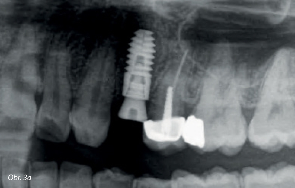 Autologní dentin – nová generace augmentačních materiálů