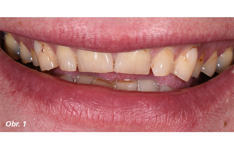 Podstatná ztráta zubní struktury, zejména ve frontálním úseku