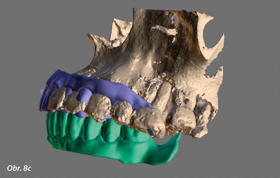 K dokončení procesu plánování byl z důvodu snahy o dosažení zavedení implantátu plně naváděného protetickými potřebami vytvořen na 3D povrchových datech DICOM diagnostický wax-up nebo virtuální set-up zubů pro zamýšlenou náhradu.