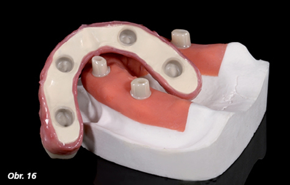 Finální protéza byla připravena pro vložení do úst pacienta