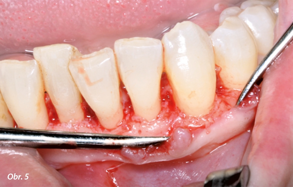 Po odstranění granulační tkáně a debridementu – ošetření kořenů dolních frontálních zubů