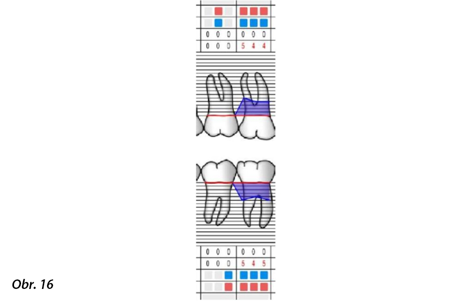 Případ 4 – Počáteční parodontologická tabulka – zaznamenané parametry ve vyšetřovaných oblastech: dolní pravý první molár (PPD, GR, BoP, PI)