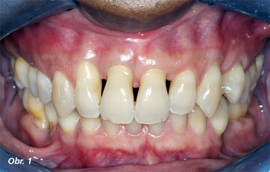Recesy postihující všechny povrchy zubu, spojované se staršími pacienty se špatnou orální hygienou
