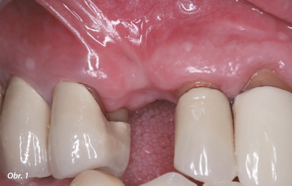 Úbytek tvrdých i měkkých tkání v oblasti zubu 13.