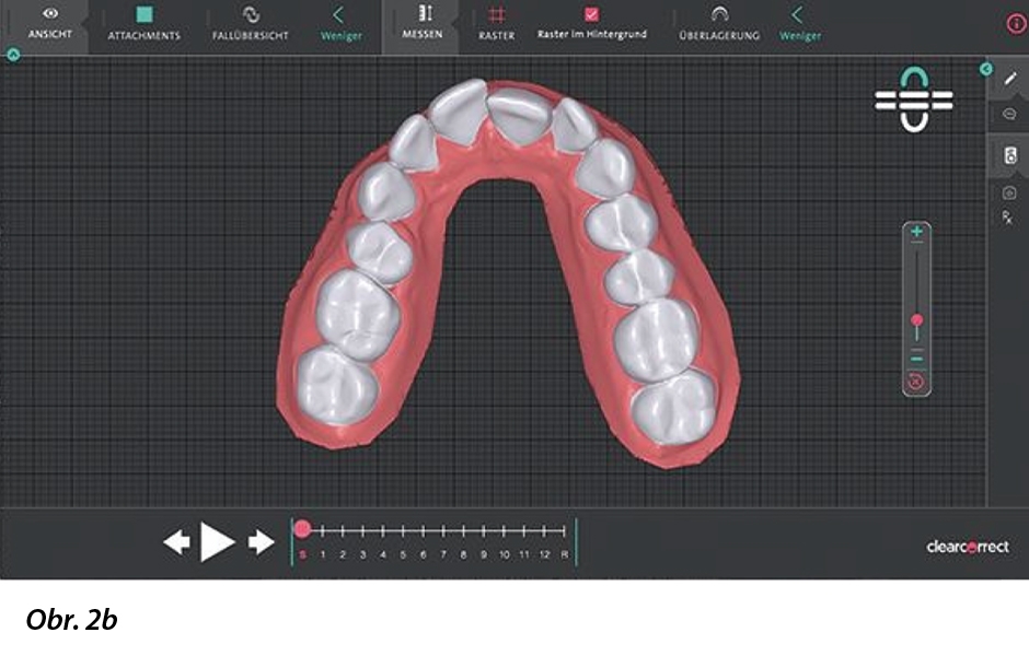 Harmonizace předních zubů po terapii alignery.