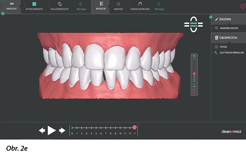 V simulačním softwaru lze analyzovat překrytí výchozí situace a zadat plánovaný výsledek, točivý moment, rotaci, extruzi a posunutí pro každý zub v jednotlivých krocích.