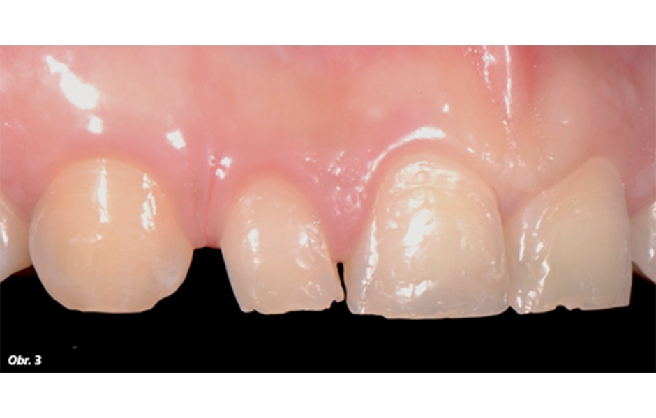 Počáteční stav klinického případu zachycující morfologii zubů v horním frontálním úseku a jejich vztah se rty a okolními tkáněmi