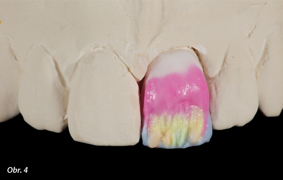 Univerzální řada materiálů IPS e.max Ceram umožňuje napodobit bělené odstíny zubů za přirozeně působícího odrazu světla.