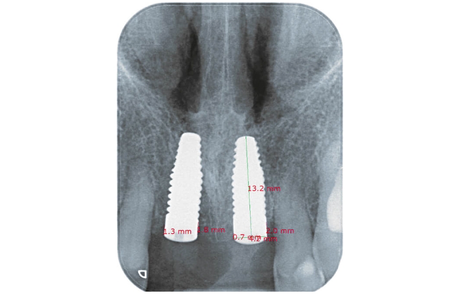 Standardizované snímky implantátových náhrad v oblasti zubů 11, 21 s naměřenými hodnotami krestální periimplantátové kosti po expozici implantátů, a dále po 6 měsících a po roce od definitivního protetického ošetření.