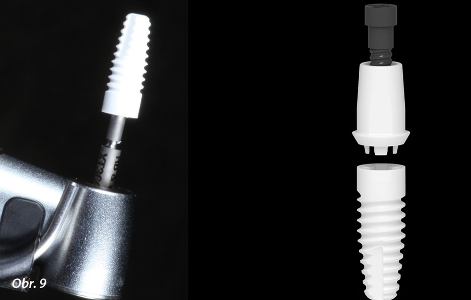 Zirkonový implantát (dvoudílný) Zeramex 4,2 × 12 mm (Dentalpoint AG) s abutmentem připevněným pomocí nekovového šroubku z materiálu vyztuženého uhlíkovými vlákny.