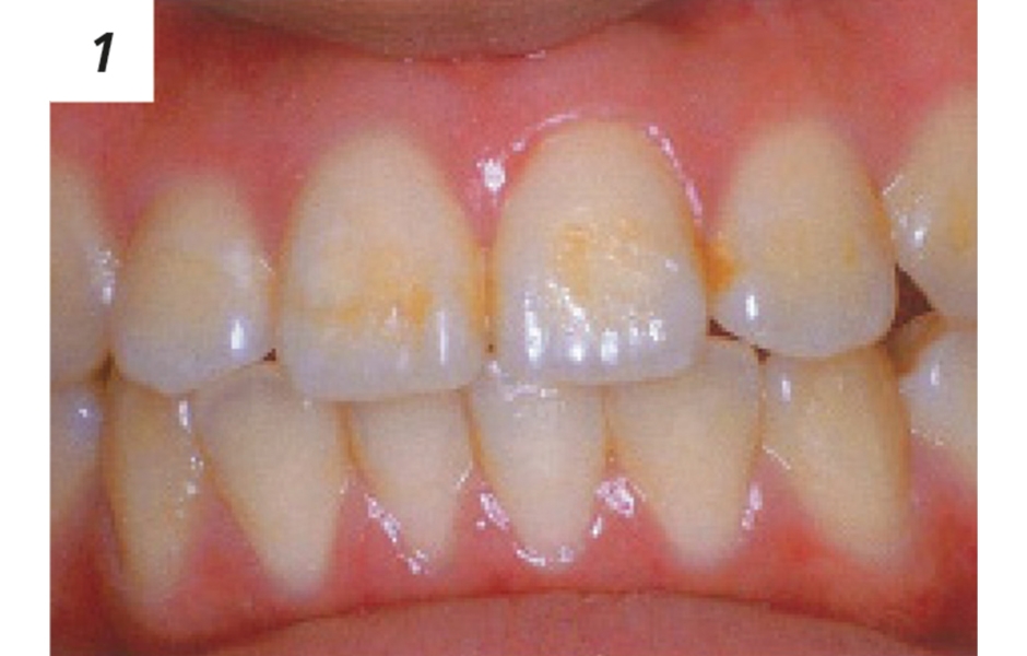 Klinický případ: Dívka, 18 let, se dostavila s částicemi cementu na zubech po odlepení ortodontických zámků na jiném pracovišti.