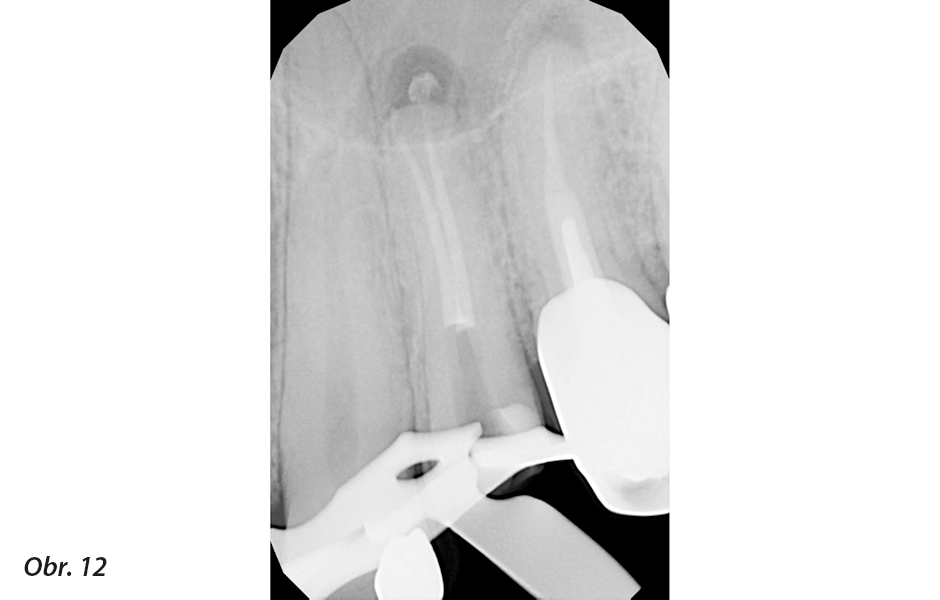 Klinické použití vysoce flexibilních nástrojů pro běžnou i složitější endodoncii<br>Nové endodontické nástroje Unicone PLUS