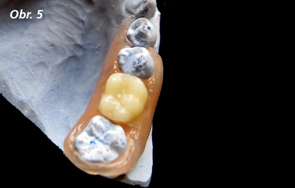 Pevné obkroužení koncového zubu defektu, kdy využijeme ke kotvení nejen plochy orální ale i aproximální